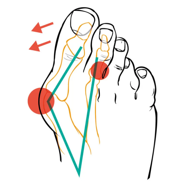 Compressana Tape Sox Hallux valgus